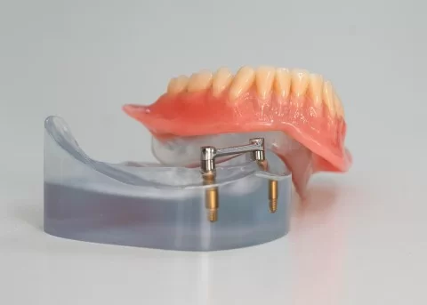 Implantaat gedragen overkappingsprothese (klikgebit)